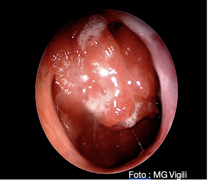 adenotomia endoscopica