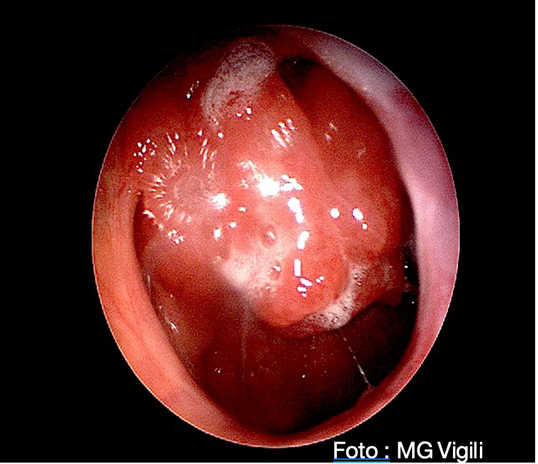 adenotomia endoscopica