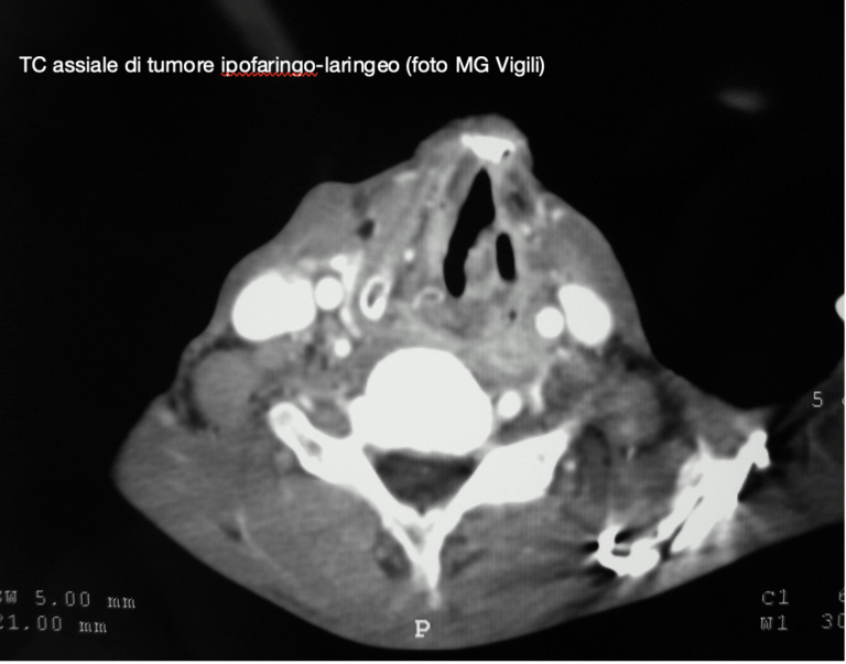 svuotamento dei linfonodi paratracheali