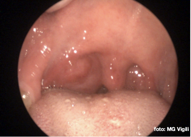 ascesso peritonsillare