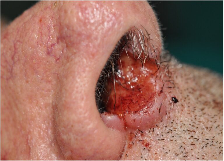 carcinoma del naso