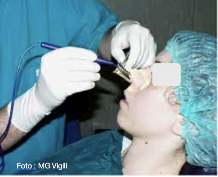 trattamento dei turbinati inferiori con radiofrequenza