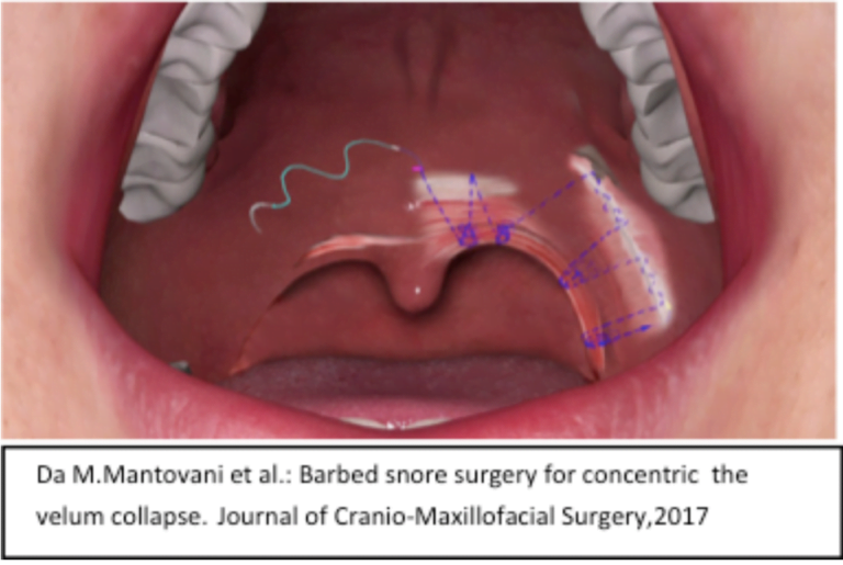 valore delle faringoplastiche
