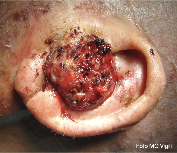 carcinoma squamoso del condotto uditivo esterno