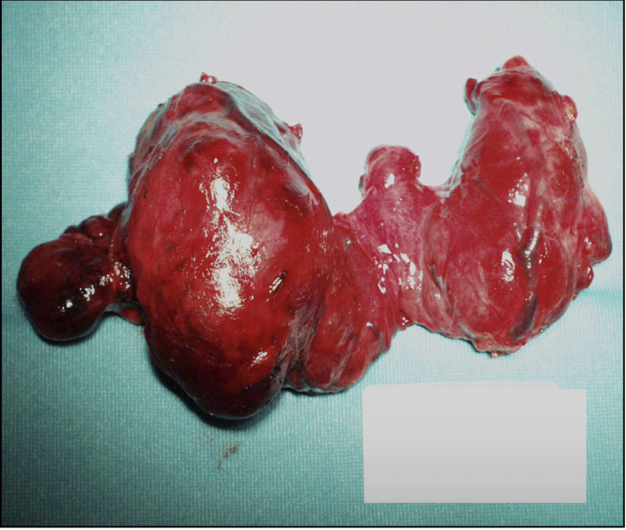 tumori della tiroide