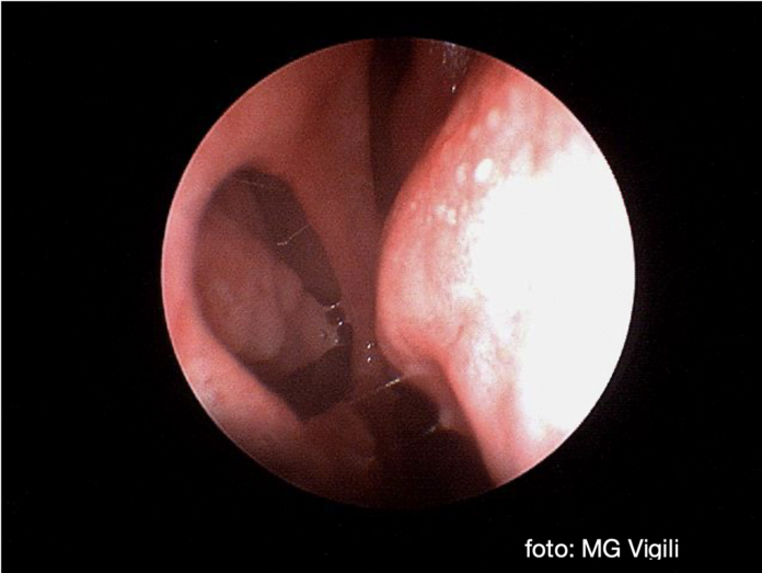 perforazione settale