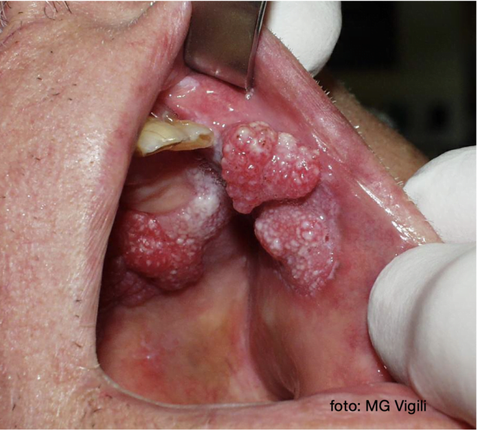 carcinoma verrucoso