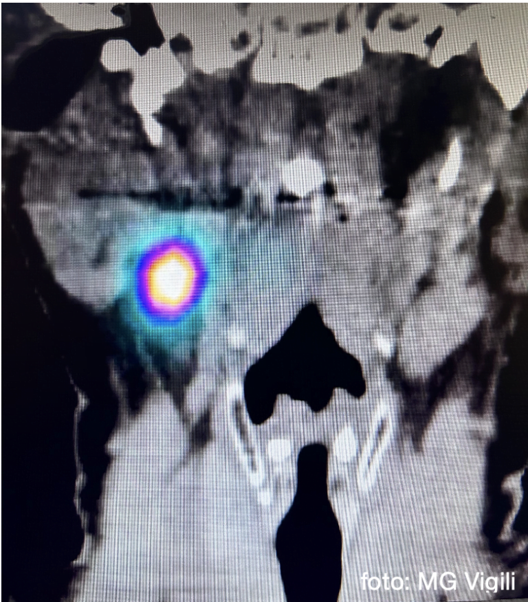 valore del linfonodo sentinella