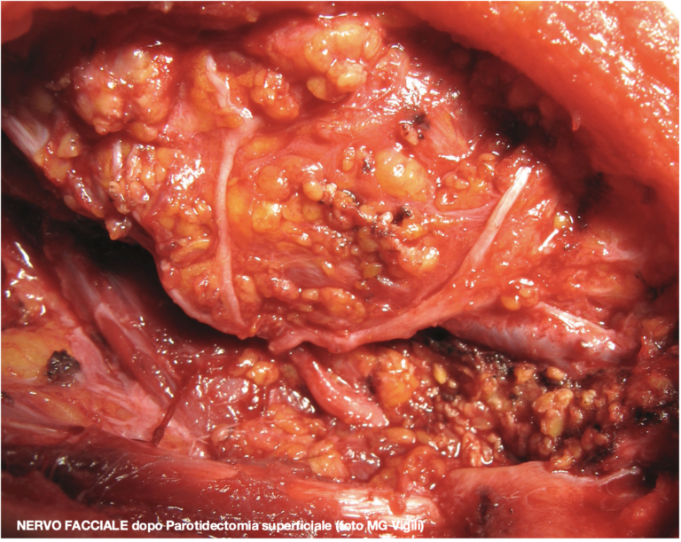 valore margini low intermediate carcinoma ghiandole salivari