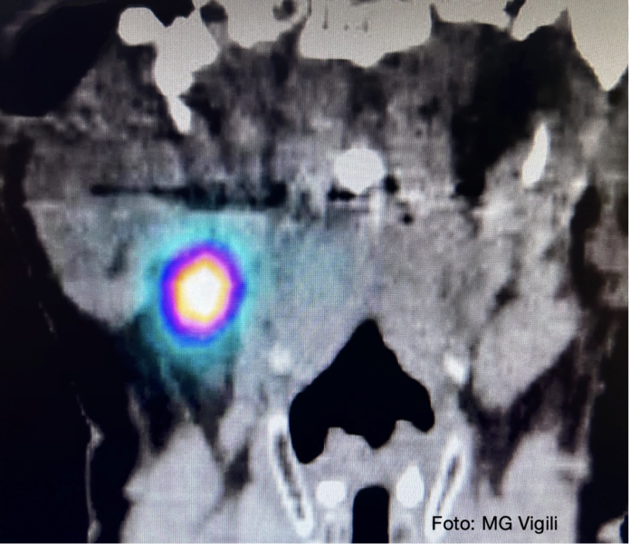 linfonodo sentinella nei t del cavo orale