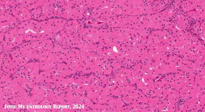 oncocitoma delle ghiandole salivari