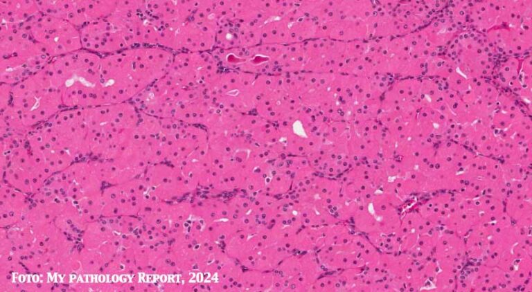 oncocitoma delle ghiandole salivari