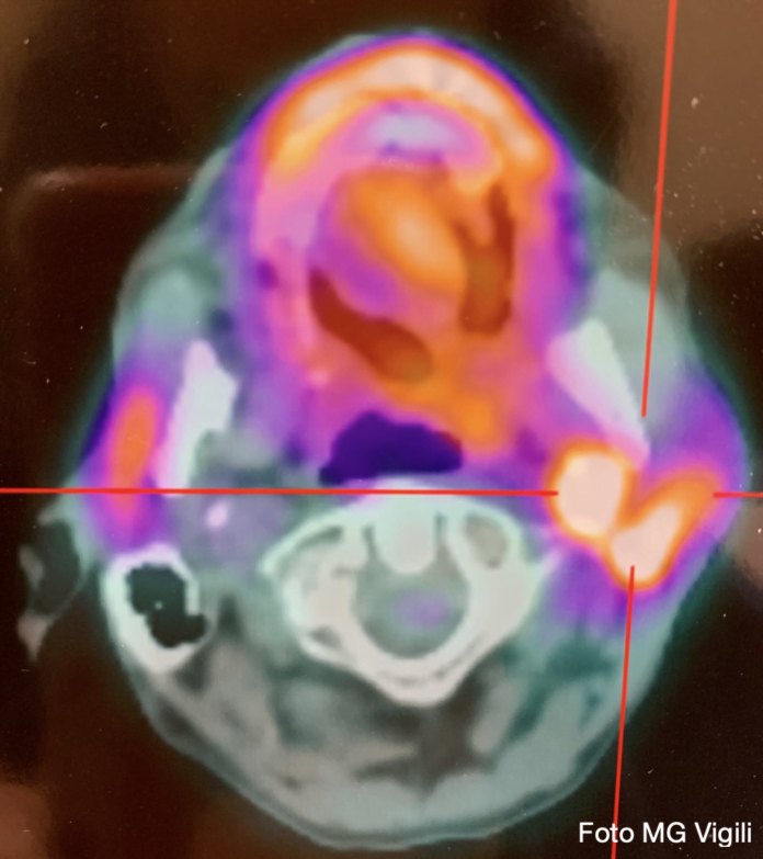 ruolo della fdg pet:ct nello studio dei linfonodi latero cervicali metastatici dei tumori testa collo a primitivita’ ignota