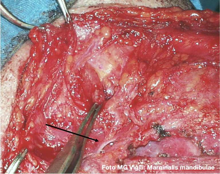 svuotamento latero cervicale radicale modificato tipo iii livelli i e ii a