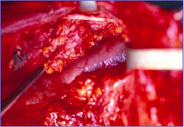 svuotamento latero cervicale radicale modificato tipo iii secondo livello b