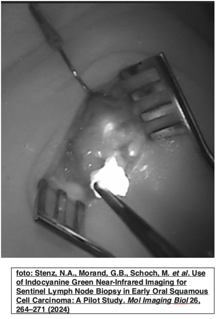 indocianina green associata alla radiocaptazione migliora identificazione intraoperatoria del linfonodo sentinella nei tumori cervico facciali