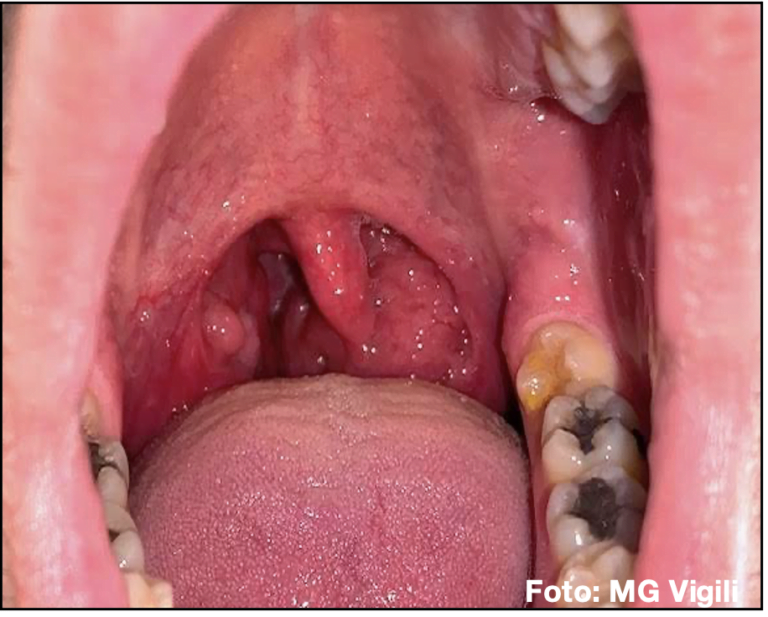tonsillectomia diagnostica