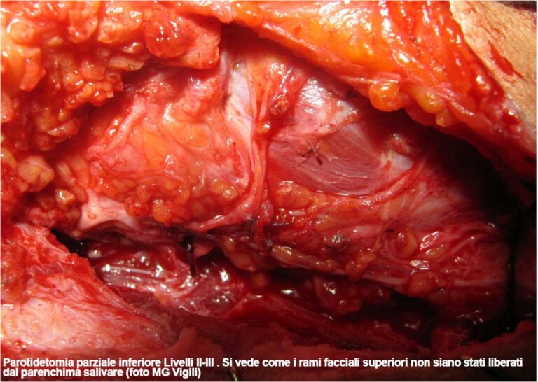 parotidectomia superficiale