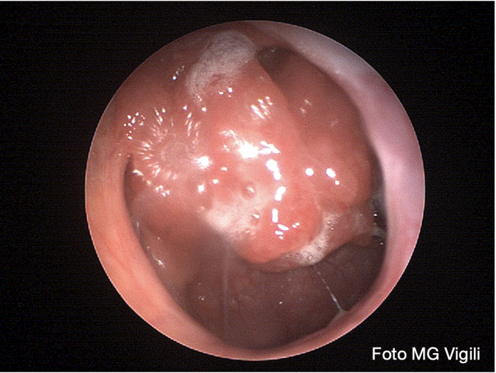 ipertrofia adenoidea
