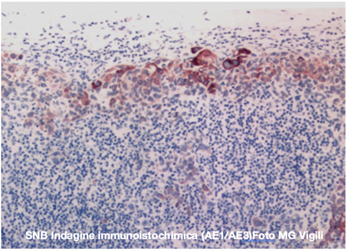fattori predittivi del valore delle micrometastasi nei linfonodi sentinella dei tumori piccoli del cavo orale