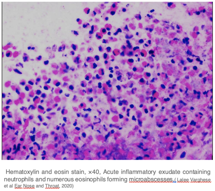 otite media eosinofila