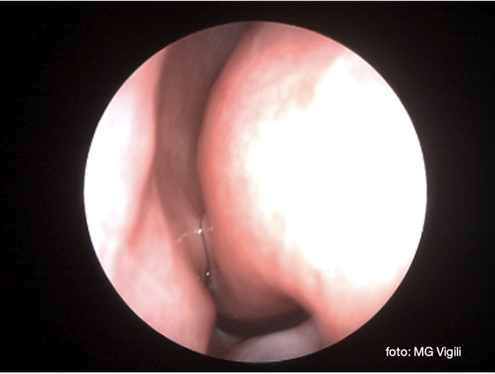 chirurgia dei turbinati
