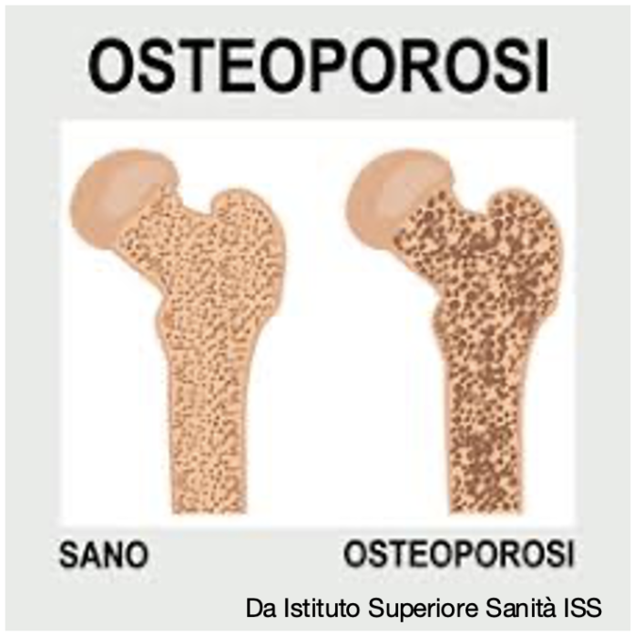 osteoporosi