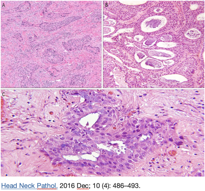 carcinoma adenosquamoso cervico facciale