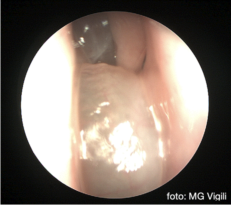 eosinofilia periferica elevata 1