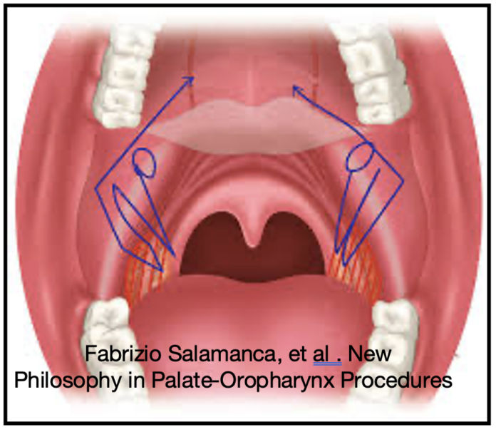 interventi di chirurgia del palato per osa