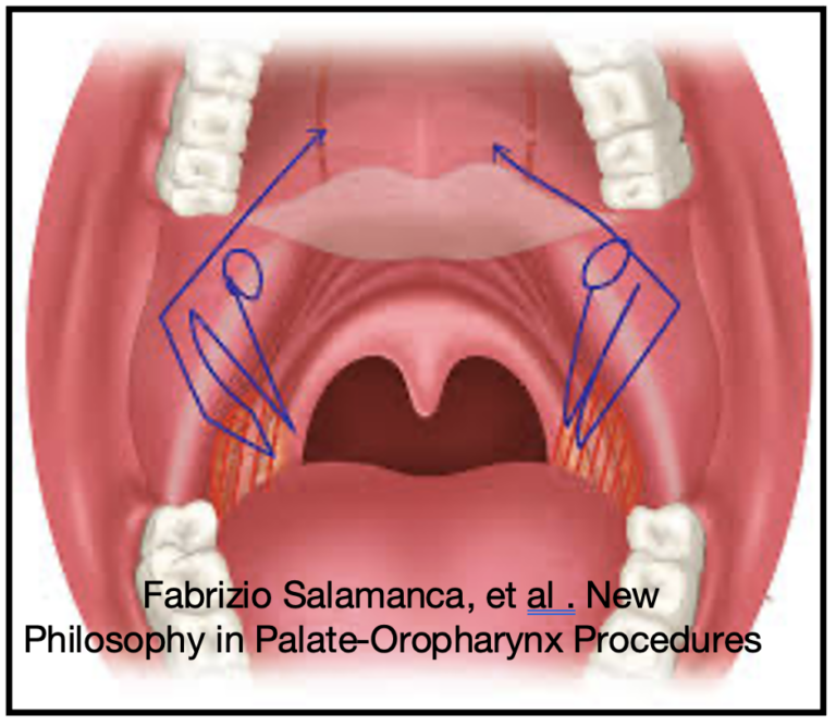 interventi di chirurgia del palato per osa