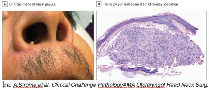 lesioni papulari del vestibolo nasale