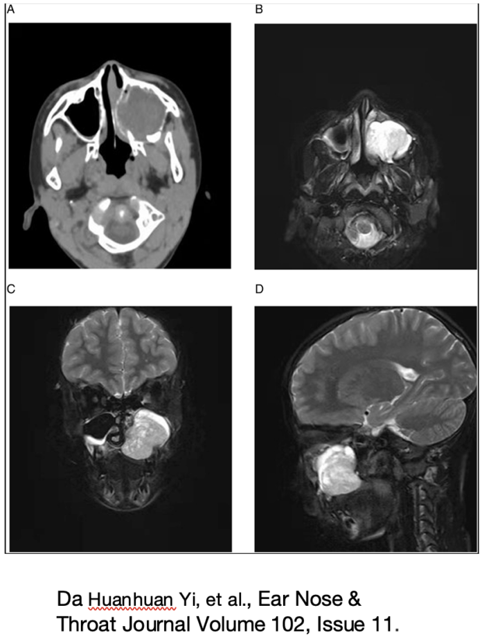 papilloma invertito in età pediatrica