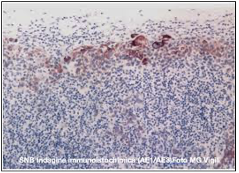 valore prognostico delle micrometastasi linfonodali nei tumori del cavo orale