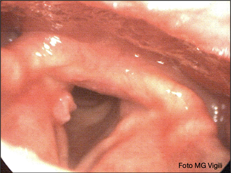 granuloma laringeo da contatto