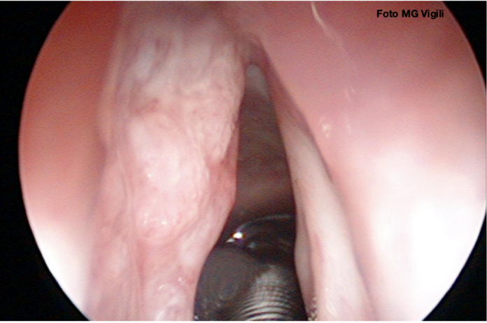tumori laringei glottici