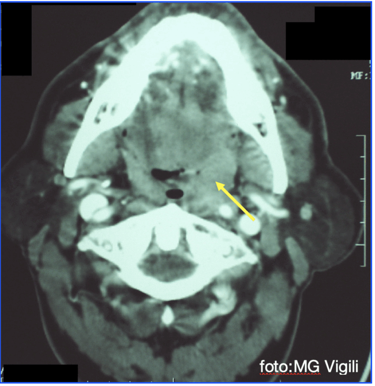 metastasi linfonodali controlaterali
