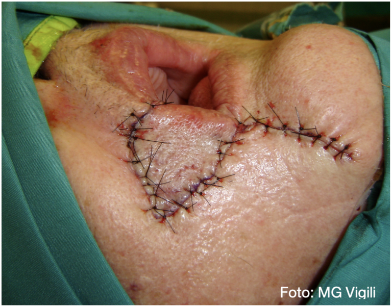 ricostruzione dopo asportazione di tumori del labbro