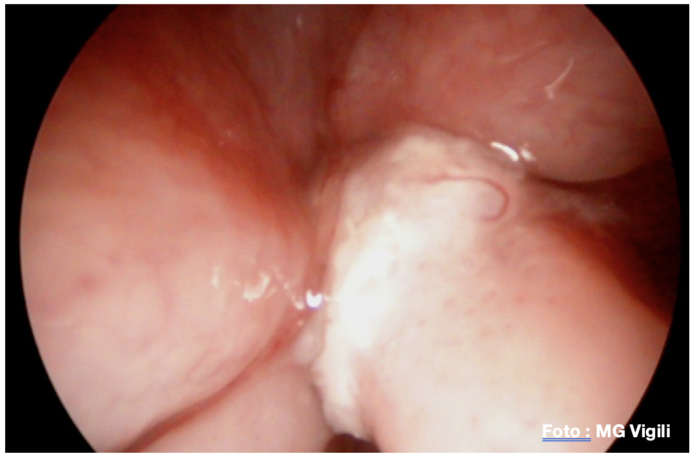 tumori glottici laser chirurgia