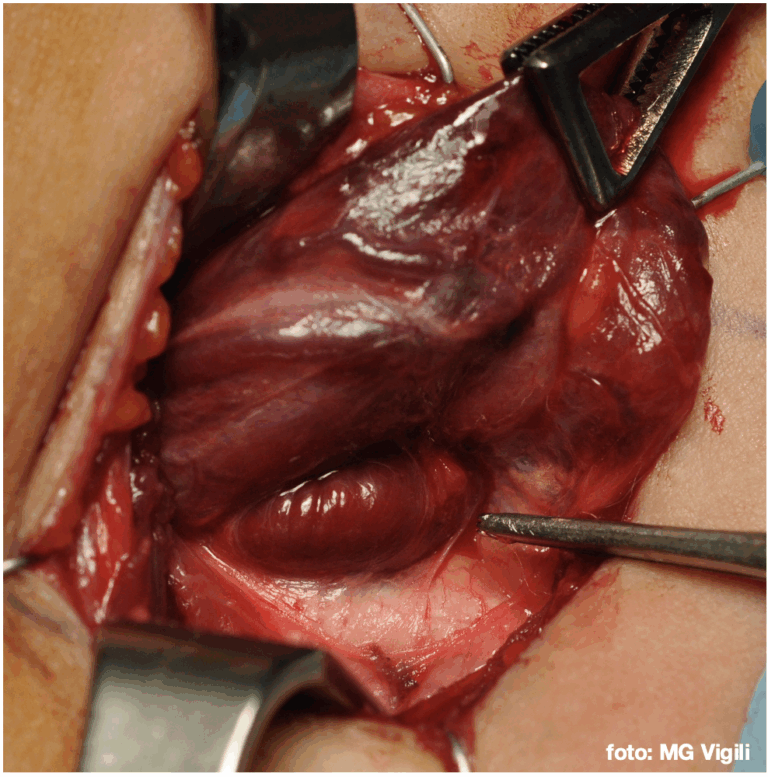 criteri di monitoraggio intraoperatorio del paratormone