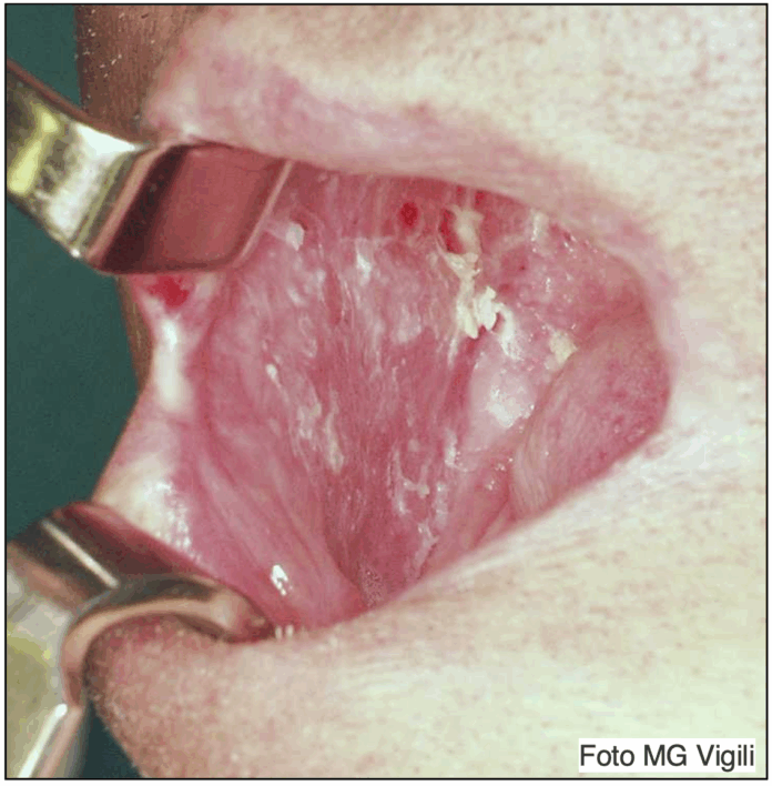 trasformazione maligna del lichen planus orale