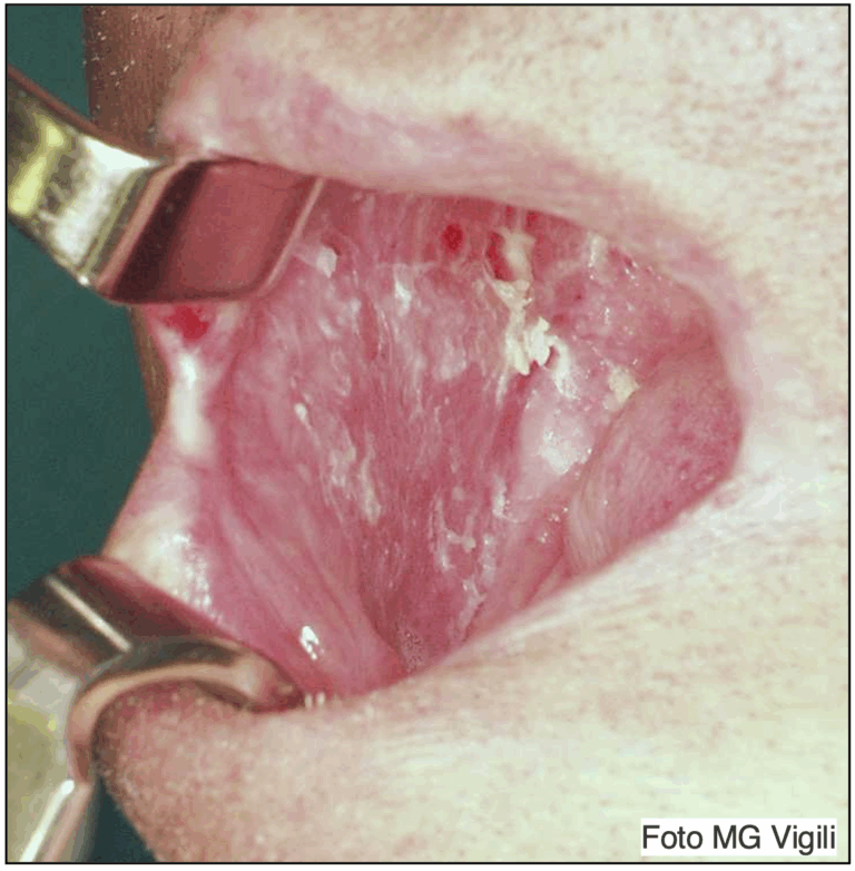 trasformazione maligna del lichen planus orale