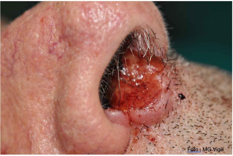 carcinoma squamoso del vestibolo nasale