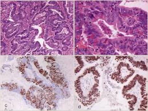 adenocarcinoma nasosinusale istologico