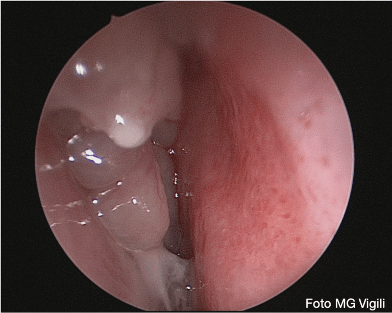 fattori predittivi di recidiva dopo chirurgia endoscopica rinosinusale per sinusite cronica polipoide