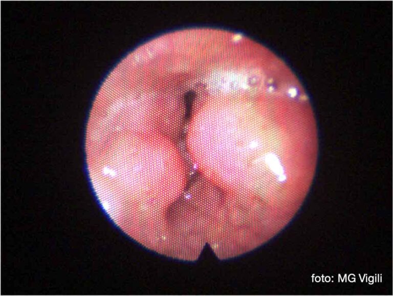 le complicanze della tonsillectomia linguale
