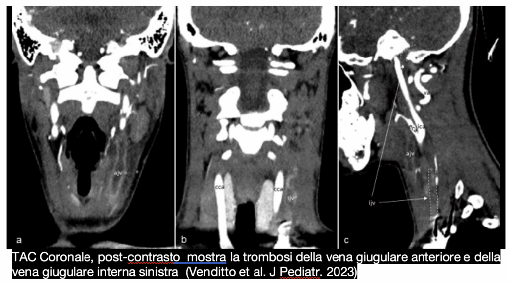 sindrome di lemierre