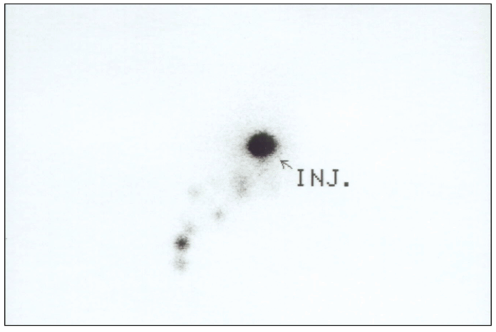 biopsia del linfonodo sentinella