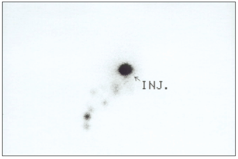 biopsia del linfonodo sentinella