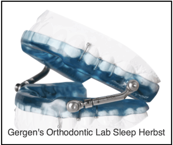 oral appliance nell’osas